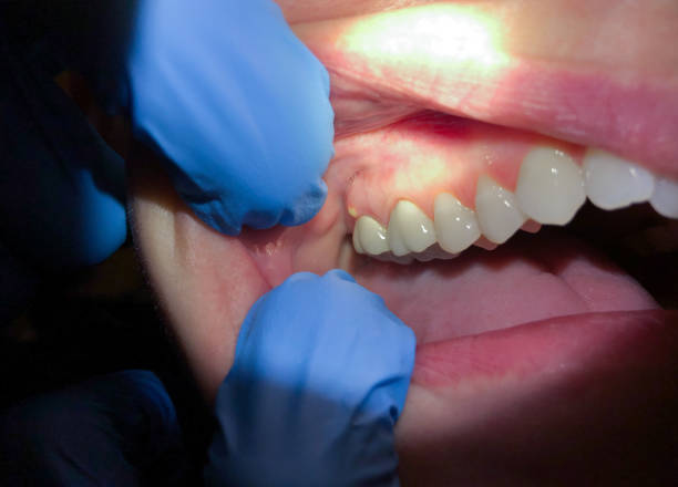 Best Emergency Dentist for Lost Fillings or Crowns in Imperial Beach, CA